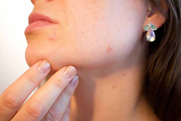 Skin Purging vs Breakout - How To Deal With It
