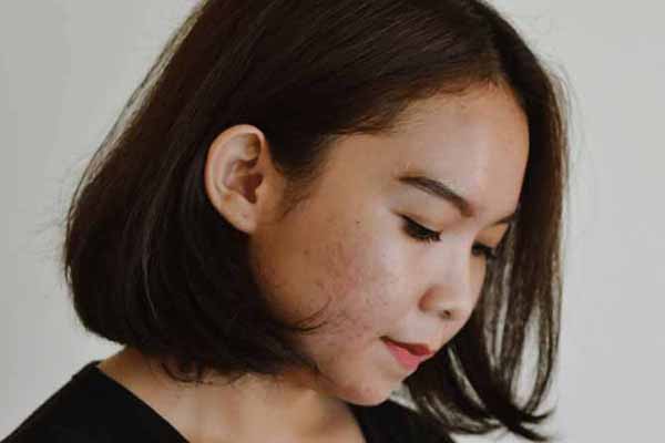 Differin (Adapalene): Everything You Need to Know