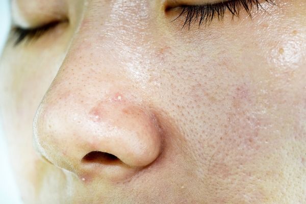 Why Is My Skin So Oily and How To Get Rid Of The Shine