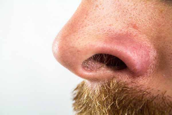 Skincare Basics: What are Blackheads?