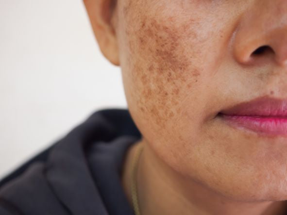 Hyperpigmentation of the Skin: Causes and How to Treat It