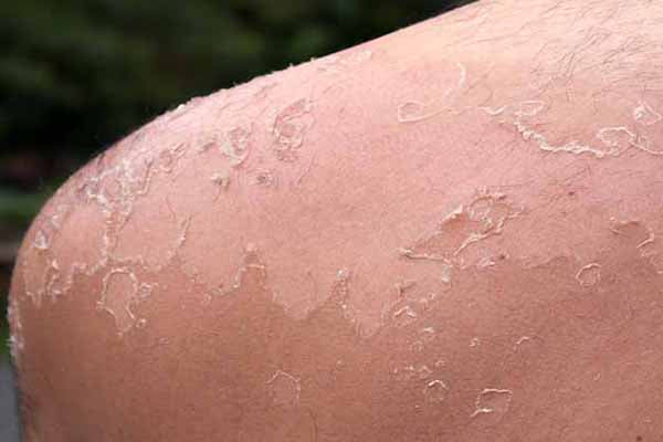 6 Tips to Heal Dry Skin Patches And Understand The Underlying Causes