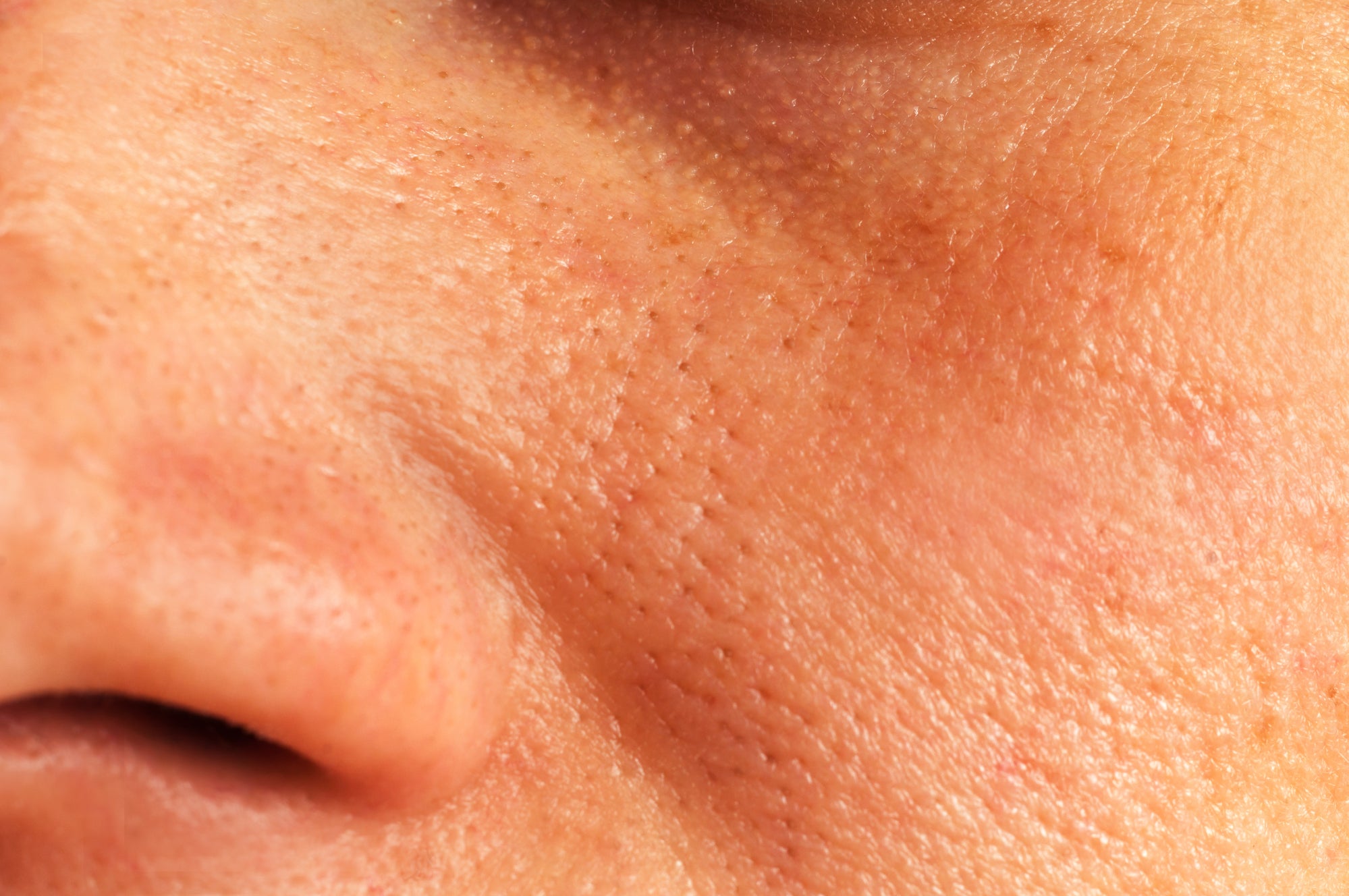 What can treat large facial pores?