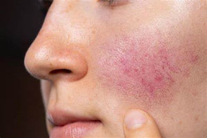 What Does Rosacea Look Like and How to Treat It