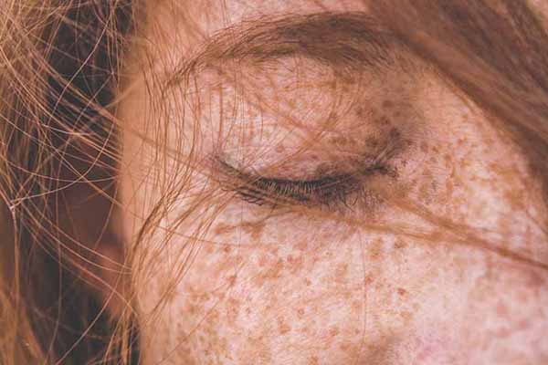What Are Freckles and How to Get Rid of Freckles